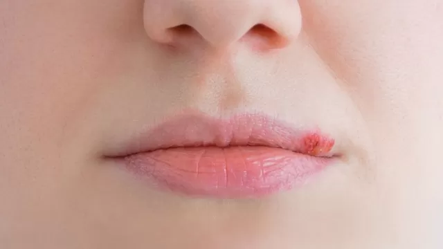 ¿Cuáles son las causas del herpes labial?
