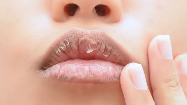 Los remedios más efectivos para los labios resecos