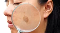 ¿Las manchas en la cara realmente se pueden quitar?