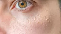 ¿Por qué aparecen estos puntitos blancos en tu piel?