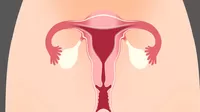 ¿Cómo evitar el crecimiento de los miomas uterinos?