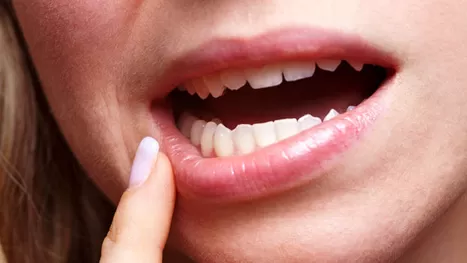 ¿Por qué salen aftas en la boca y cómo puedes prevenirlas?