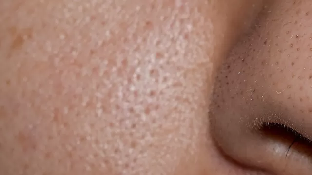 Lo que debes saber sobre los poros abiertos en el rostro