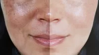 ¿Cómo limpiar tu rostro si tienes los poros abiertos?
