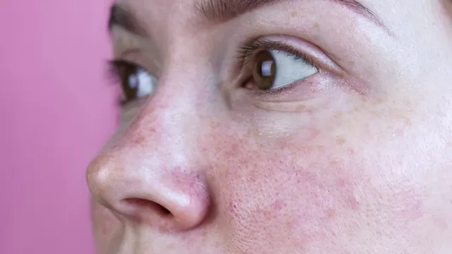 Lo que debes saber sobre los poros abiertos que aparecen en la cara