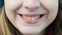 ¿Por qué los dientes nuevos de los niños salen amarillos?