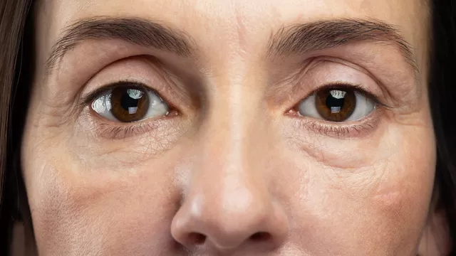 ¿Cuál es la causa de que se formen bolsas en los ojos?