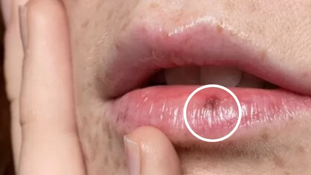 Los labios oscuros y sus causas dermatológicas.