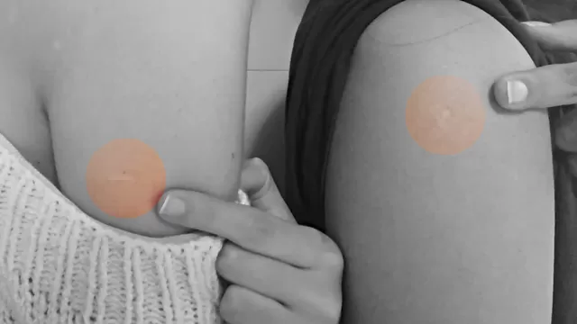 Marca de la vacuna BCG. (Foto: Útil e Interesante)