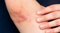 Psoriasis: causas y tratamiento de esta enfermedad en la piel
