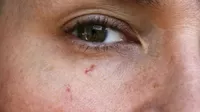 ¿Por qué aparecen estas venitas rojas en la cara?