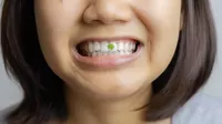 ¿Por qué no es normal que la comida quede atorada entre tus dientes?