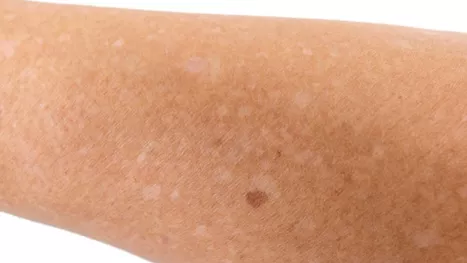 ¿Por qué salen estas manchas blancas en la piel?