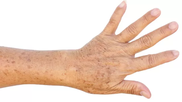 Existen diversos factores que provocan la aparición de manchas en la piel