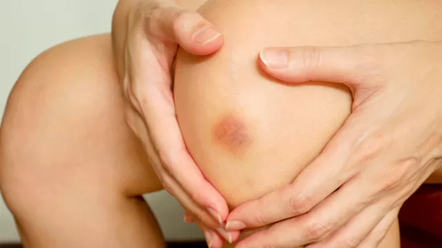 Especialistas detallaron las causas de los hematomas en tu piel