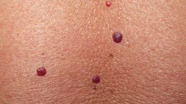 Especialistas recomiendan cómo eliminar esos puntitos rojos en tu piel