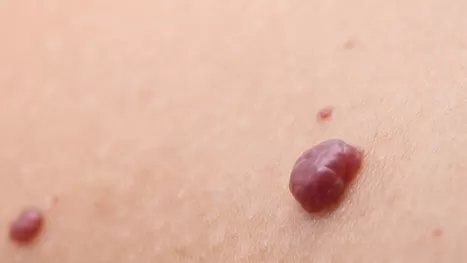 ¿Por qué salen lunares rojos en la piel y cómo prevenir su aparición?