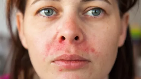 ¿Qué causa la dermatitis seborreica y quiénes tienen más riesgo?