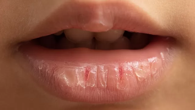 Causas de los labios resecos