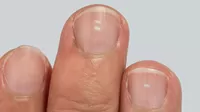 ¿Qué significan las manchas en las uñas y cuándo debes preocuparte?