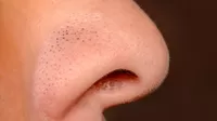 ¿Qué son esos puntos negros en tu nariz y por qué no puedes quitarlos?