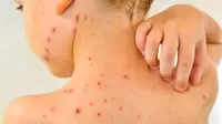 ¿Por qué el virus de la varicela puede provocar herpes?