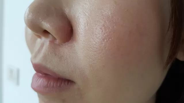 Una dermatóloga nos explica lo que debes saber sobre los poros abiertos