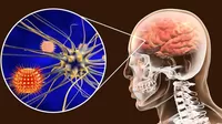 ¿Cuáles son los síntomas de la meningitis y cómo se contagia?
