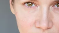 Tratamiento para eliminar las venitas rojas del rostro