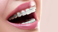 ¿Los dientes y muelas pueden moverse pese a haber usado brackets?